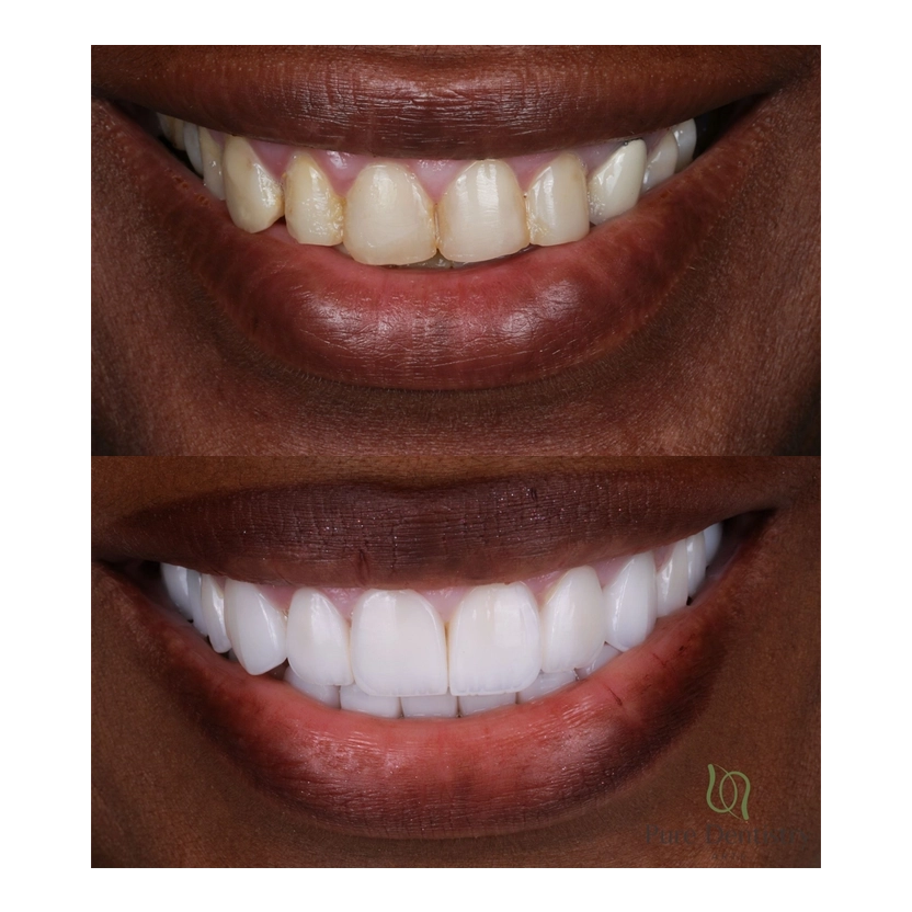 Dental veneers patient smile at Pure Dentistry Arts